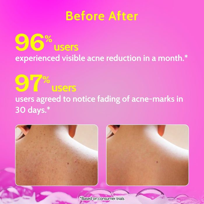 1% Salicylic Acid Body Wash with Lactic Acid | for Acne Control - 236 ml