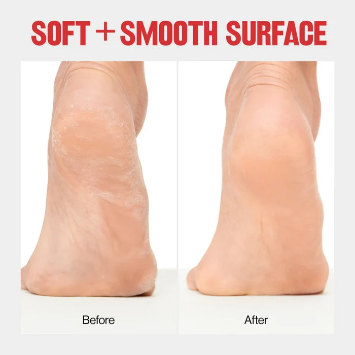 REVLON Callus Remover With Catcher اداة العناية بالقدم من ريفلون